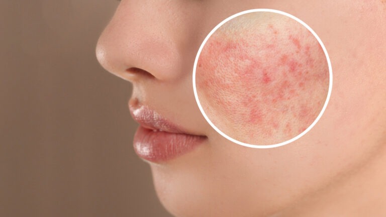 Breaking the Cycle of Rosacea